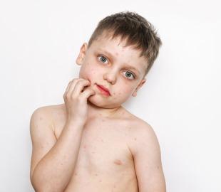 Criança com erupções vermelhas na pele, simbolizando os sintomas do sarampo, com a mão na bochecha e expressão de desconforto.