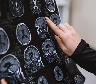 Mão apontando para imagens de ressonância magnética (RM) do cérebro, ilustrando o diagnóstico e estudo da epilepsia.