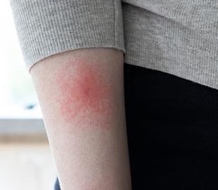 Braço com uma erupção cutânea circular avermelhada, característica da Doença de Lyme (eritema migratório).