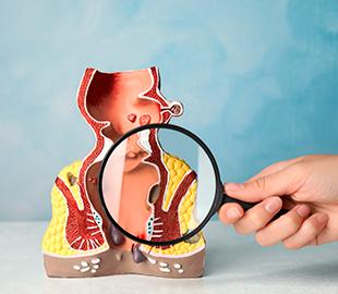 Mão segurando uma lupa sobre um modelo anatômico do trato gastrointestinal inferior (cólon e reto), simbolizando o foco do proctologista.