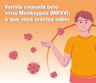 Ilustração de uma pessoa com lesões na pele, cercada por representações do vírus Monkeypox, simbolizando os sintomas da varíola causada pelo vírus MPXV.